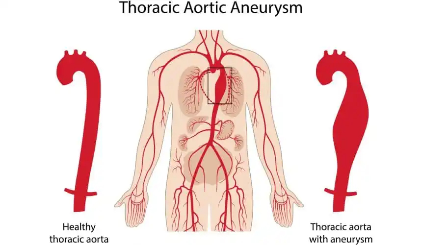 Abdominal Aortic Aneurysm1